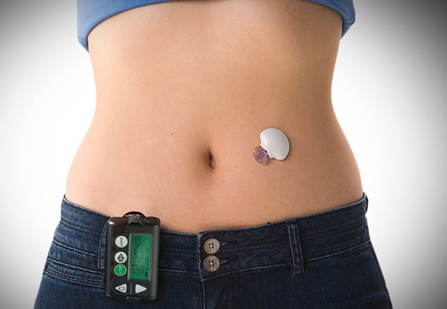 Artificial Pancreas Explained