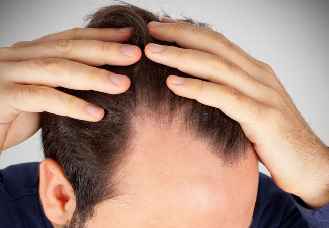 Does Diabetes Cause Hair Loss?